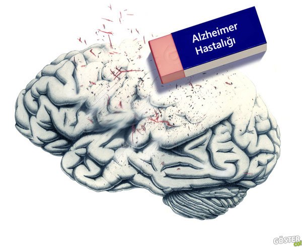 alzheimer